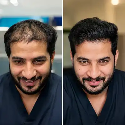 Before and after results of a hair transplant procedure at Reversage Clinic